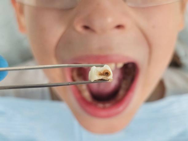 Best Emergency Root Canal Treatment in Roland, AR