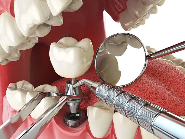 Best Emergency Root Canal Treatment in Roland, AR